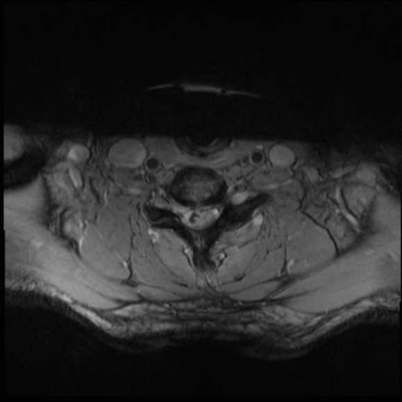 File:Cervical disc extrusion (Radiopaedia 53950-60077 Axial T2 25).jpg
