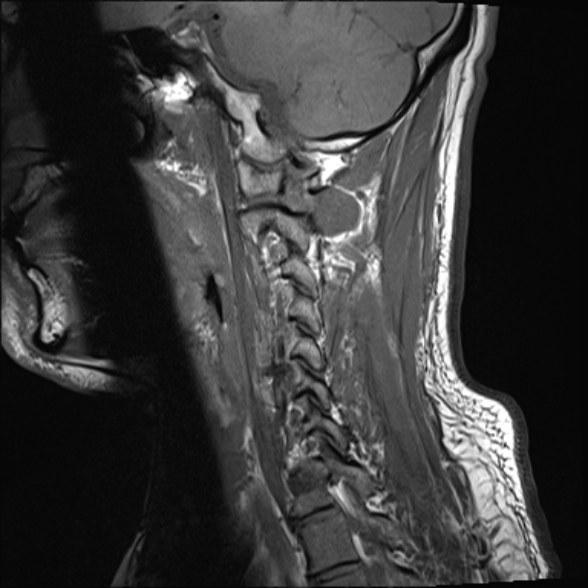 File:Cervical disc extrusion (Radiopaedia 53950-60077 Sagittal T1 14).jpg