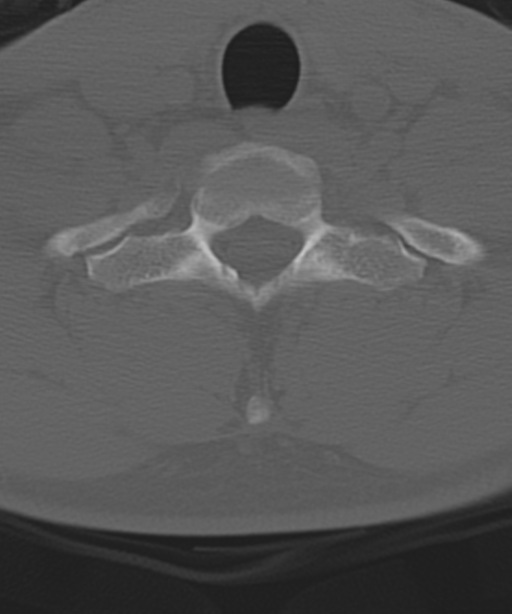 Cervical intercalary bone (Radiopaedia 35211-36748 Axial bone window 55).png