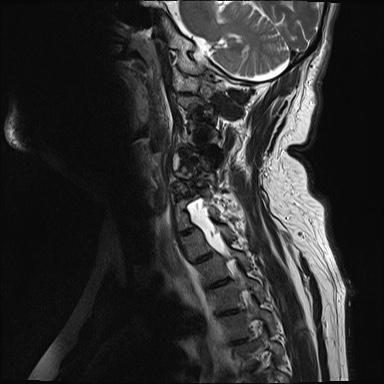 File:Cervical spinal neurofibroma in a patient with NF1 (Radiopaedia 58344-65465 Sagittal T2 9).jpg