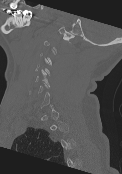 Cervical spine fractures with vertebral artery dissection (Radiopaedia 53296-59268 Sagittal bone window 53).png