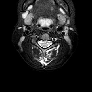 File:Cervical spine posterior ligamentous complex rupture (Radiopaedia 63486-72103 Axial T2 16).jpg