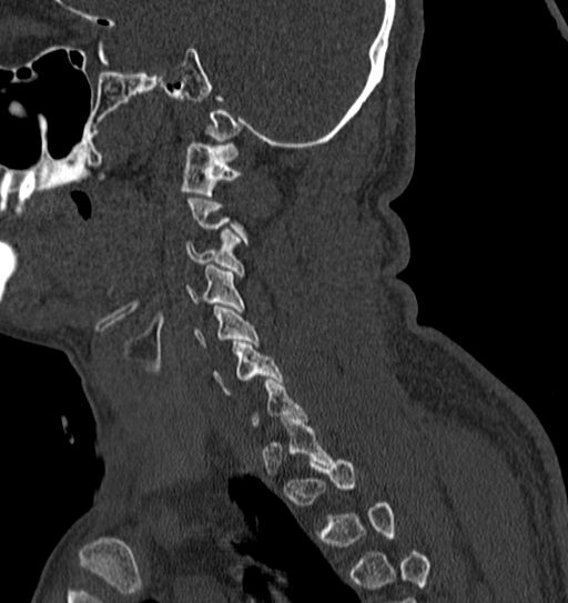 File:Cervical spine trauma with tear drop fracture and perched facet joint (Radiopaedia 53989-60127 Sagittal bone window 31).jpg