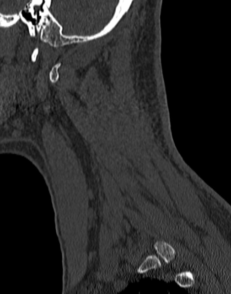 File:Cervical spondylodiscitis (Radiopaedia 28057-29489 Sagittal bone window 54).jpg