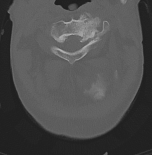 File:Cervical spondylolysis (Radiopaedia 49616-54811 Axial bone window 15).png
