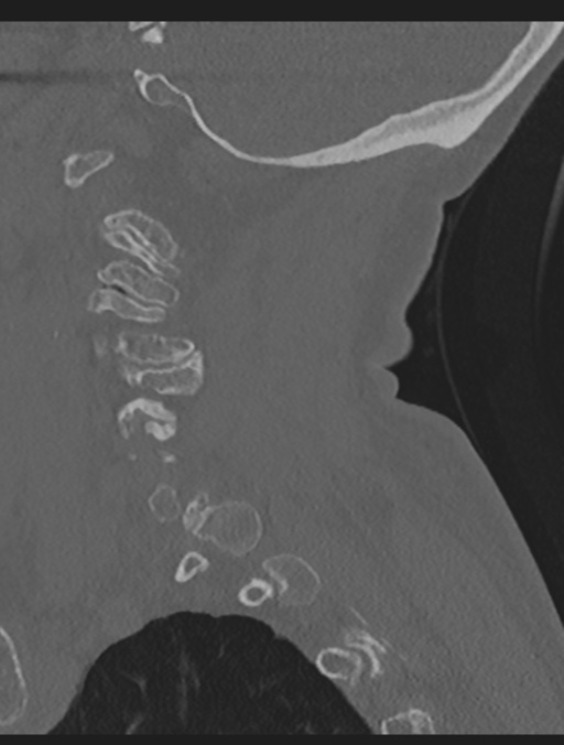 Cervical spondylolysis (Radiopaedia 49616-54811 Sagittal bone window 18).png