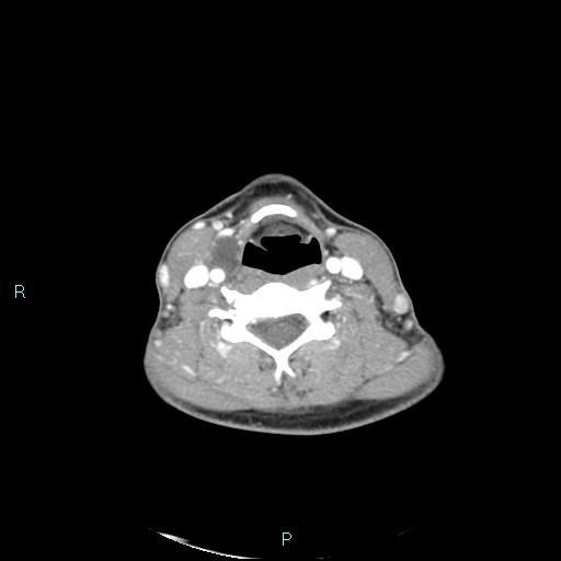 Cervical thymic cyst (Radiopaedia 88632-105335 B 54).jpg
