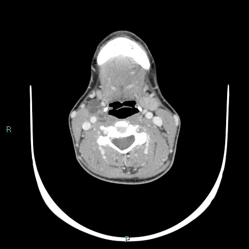 Cervical thymic cyst (Radiopaedia 88632-105335 C 65).jpg