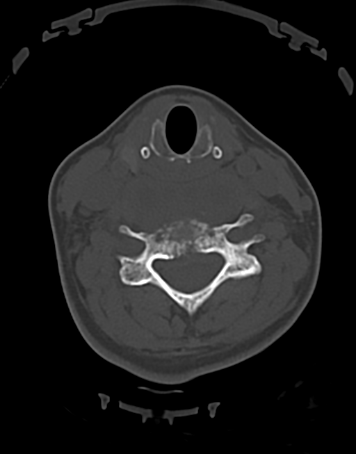 Cervical tuberculous spondylitis (Radiopaedia 39149-41365 Axial bone window 31).png