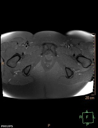 File:Cesarian scar endometriosis (Radiopaedia 68495-78066 Axial T1 fat sat 24).jpg