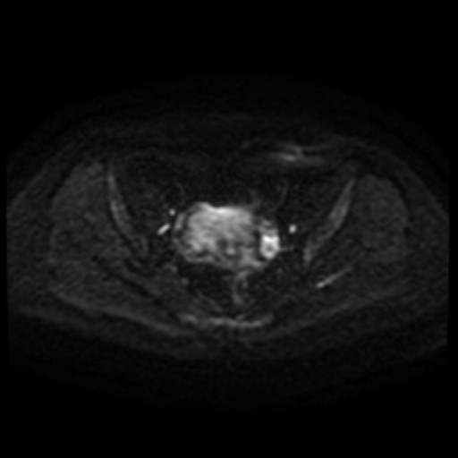 Cesarian section scar endometriosis (Radiopaedia 66520-75799 Axial DWI 86).jpg