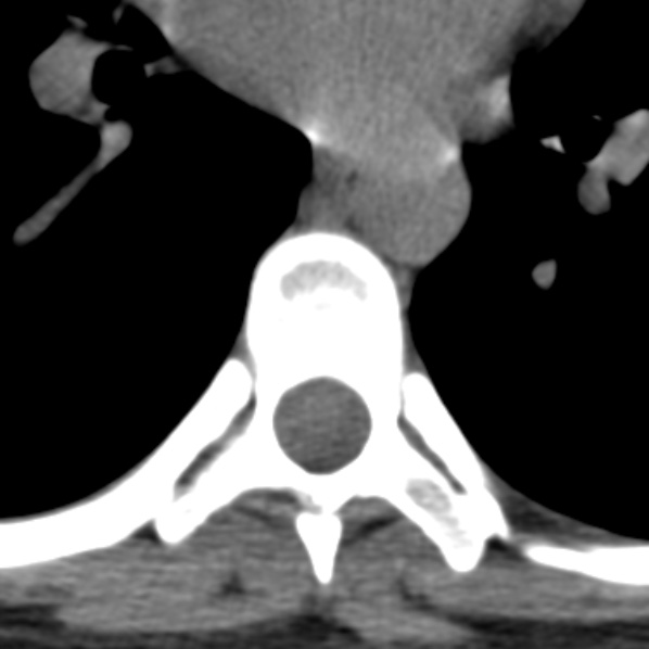 File:Chance fracture (Radiopaedia 36521-38081 Axial non-contrast 6).jpg