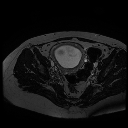 Chiari II malformation - fetal MRI (Radiopaedia 68099-77581 Axial Fiesta 50).jpg