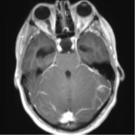File:Chiari I malformation and obstructive hydrocephalus (Radiopaedia 41185-43978 Axial T1 C+ 12).png