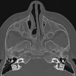 Choanal atresia (Radiopaedia 88525-105975 Axial bone window 37).jpg