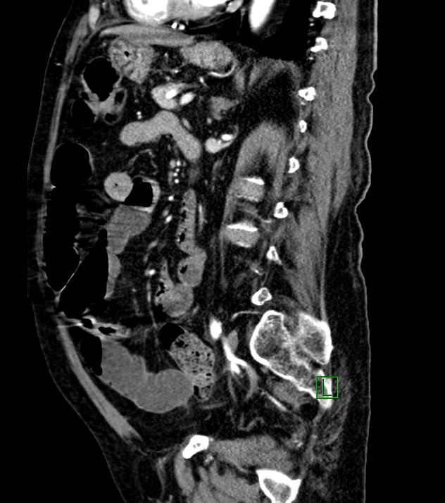 Cholangiocarcinoma with cerebral metastases (Radiopaedia 83519-98629 F 51).jpg