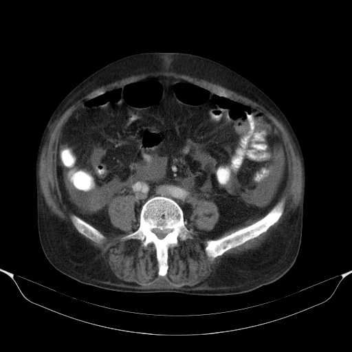 File:Cholangitis and abscess formation in a patient with cholangiocarcinoma (Radiopaedia 21194-21100 A 33).jpg