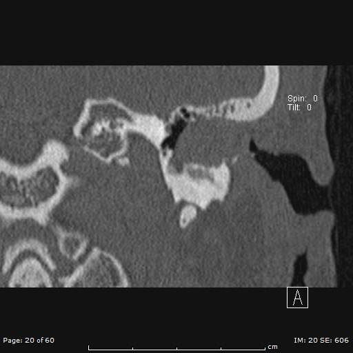 File:Cholesteatoma - external auditory canal (Radiopaedia 88452-105096 Coronal bone window 20).jpg
