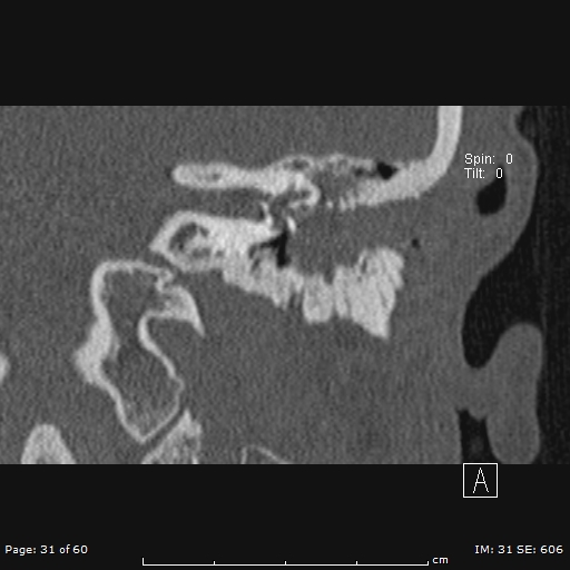 Cholesteatoma - external auditory canal (Radiopaedia 88452-105096 Coronal bone window 31).jpg