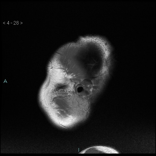 File:Cholesterol granuloma of the petrous apex (Radiopaedia 64358-73140 Sagittal T1 28).jpg