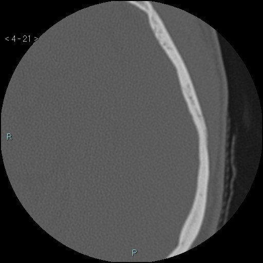 File:Cholesterol granuloma of the petrous apex (Radiopaedia 64358-73141 Axial bone window 10).jpg