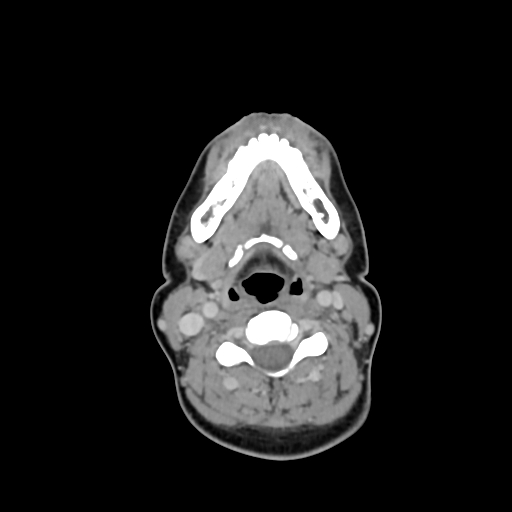 File:Chondroblastic osteosarcoma (Radiopaedia 67363-76741 Axial with contrast 17).jpg