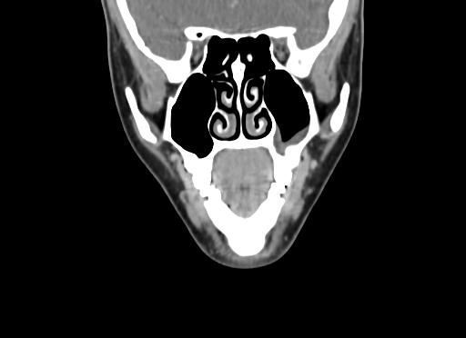File:Chondroblastic osteosarcoma (Radiopaedia 67363-76741 D 33).jpg