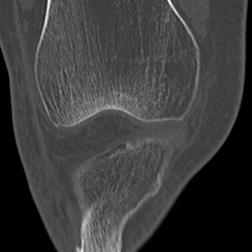 Chondrocalcinosis (Radiopaedia 16275-15955 Coronal bone window 22).jpg