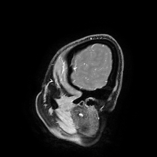 Chordoid glioma of third ventricle (Radiopaedia 91612-109340 F 31).jpg