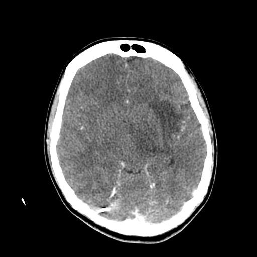 File:Choriocarcinoma of ovary with cerebral and pulmonary metastases (Radiopaedia 25983-26118 C+ arterial phase 75).jpg