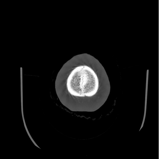 Choroid plexus papilloma extending into the cerebellopontine angle cistern (Radiopaedia 85941-101833 Axial bone window 90).png