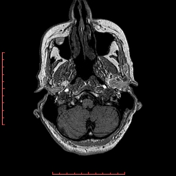 File:Choroid plexus xanthogranuloma (Radiopaedia 67843-77270 Axial T1 141).jpg