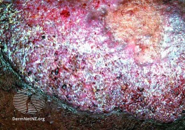 File:Chromoblastomycosis (DermNet NZ fungal-chroclo).jpg