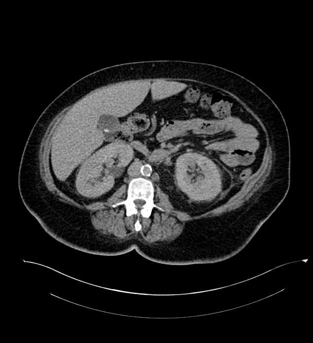 Chromophobe renal cell carcinoma (Radiopaedia 84239-99519 E 82).jpg