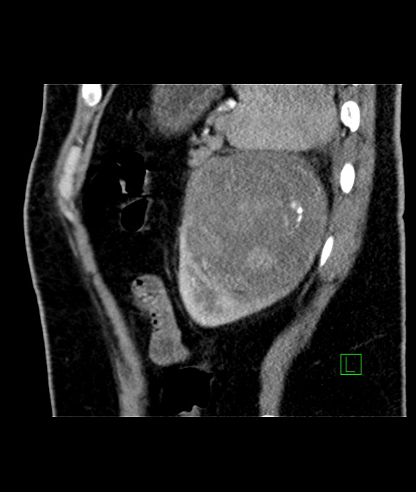 Chromophobe renal cell carcinoma (Radiopaedia 84255-99542 E 13).jpg