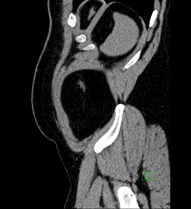 Chromophobe renal cell carcinoma (Radiopaedia 84286-99573 C 11).jpg
