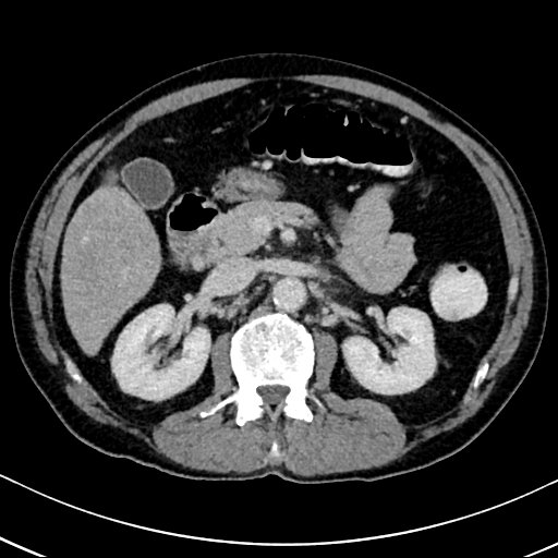 Chronic appendicitis complicated by appendicular abscess, pylephlebitis and liver abscess (Radiopaedia 54483-60700 B 62).jpg