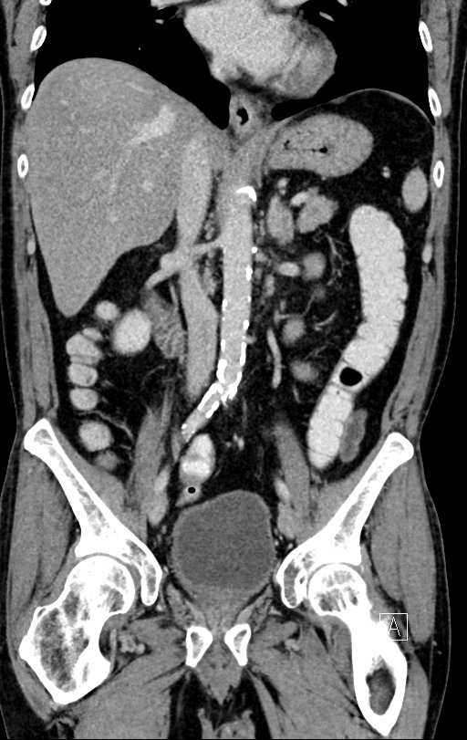 Chronic appendicitis complicated by appendicular abscess, pylephlebitis and liver abscess (Radiopaedia 54483-60700 C 43).jpg
