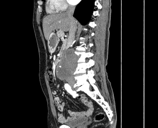 Chronic contained rupture of abdominal aortic aneurysm with extensive erosion of the vertebral bodies (Radiopaedia 55450-61901 B 20).jpg
