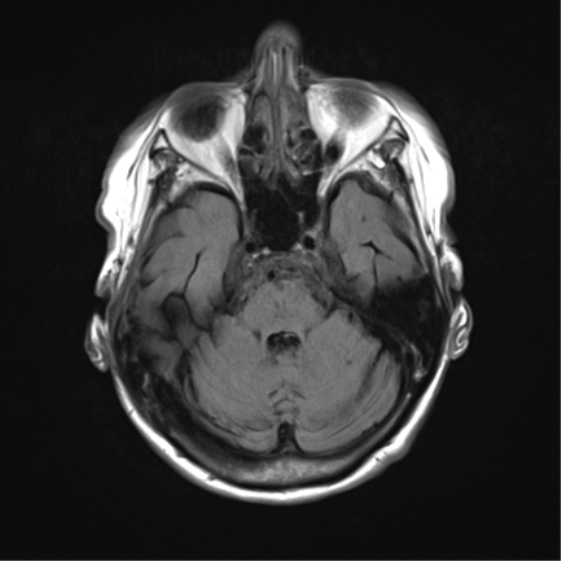 File:Chronic hypertensive encephalopathy (Radiopaedia 72844-83495 Axial FLAIR 7).png