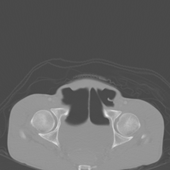 Chronic large bowel pseudo-obstruction (Radiopaedia 43181-46492 Axial bone window 155).jpg