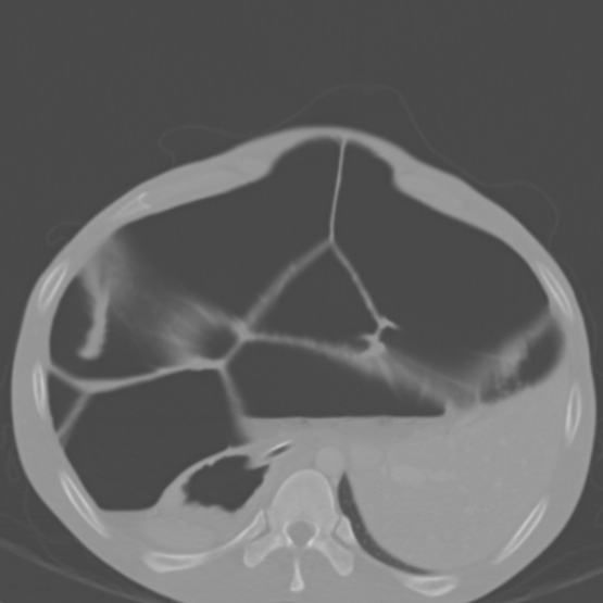 Chronic large bowel pseudo-obstruction (Radiopaedia 43181-46492 Axial bone window 48).jpg