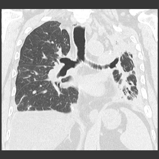 Chronic lung allograft dysfunction - restrictive form (Radiopaedia 60595-68316 Coronal lung window 61).jpg