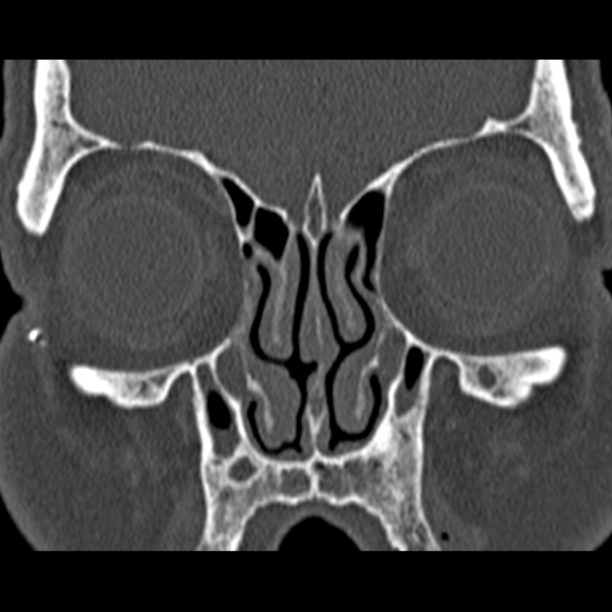 Chronic maxillary sinusitis (Radiopaedia 27879-28116 Coronal bone window 17).jpg