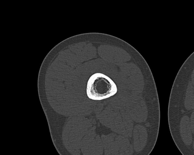 Chronic ostemyelitis of the femur with long sinus tract (Radiopaedia 74947-85982 Axial bone window 115).jpg