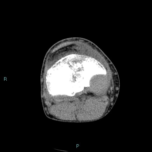 Chronic osteomyelitis (with Brodie abscess) (Radiopaedia 76405-88111 A 106).jpg