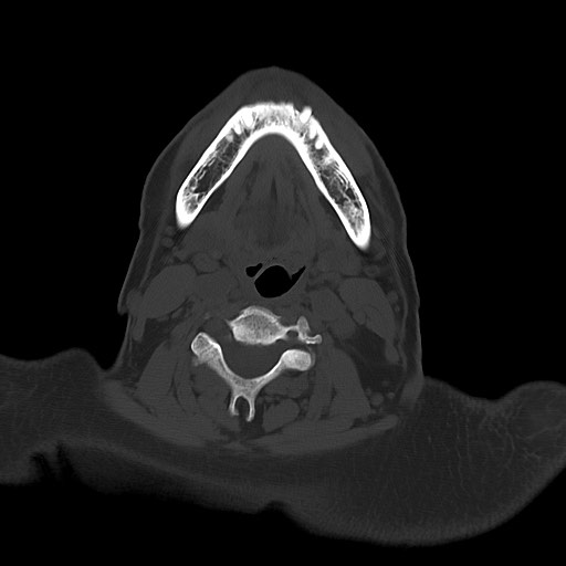 File:Chronic osteomyelitis - calvarial (severe) (Radiopaedia 69668-79616 Axial bone window 4).jpg