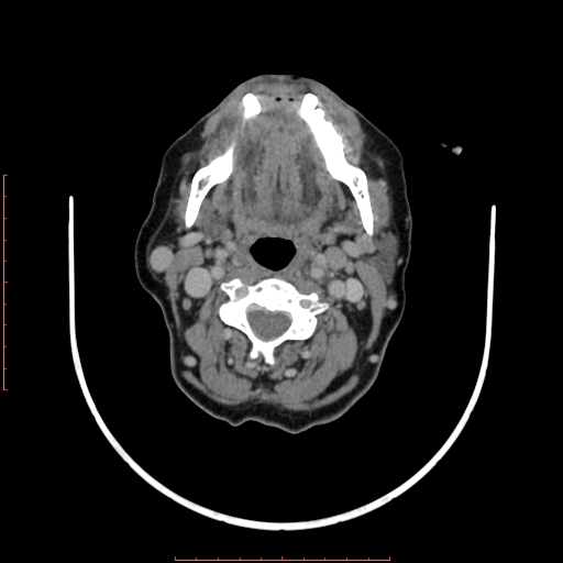 File:Chronic osteomyelitis - maxilla (Radiopaedia 23783-23927 B 20).jpg