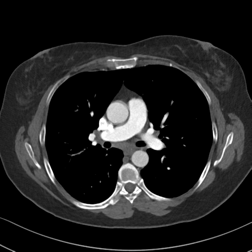 Chronic pulmonary embolus (Radiopaedia 39129-41341 Axial C+ CTPA 48).png