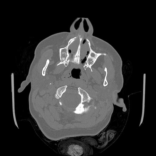 Chronic sinusitis with intra-sinus calcification (Radiopaedia 63919-72668 Axial bone window 75).jpg